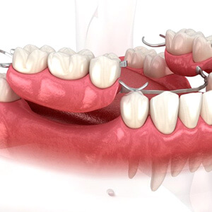 illustration of partial dentures