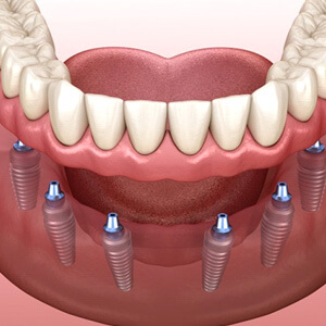 illustration of implant dentures