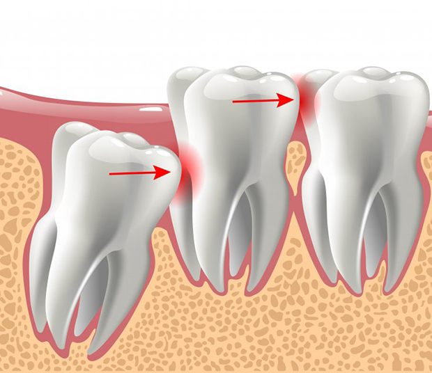 Illustration of impacted molar