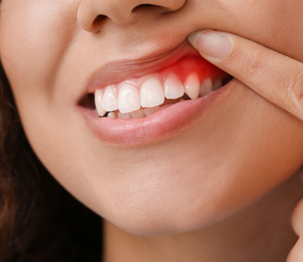 A woman revealing her red and inflamed gum tissue